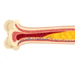 Aortic Valve Surgery
