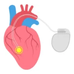 Pacemaker / ICD Implant